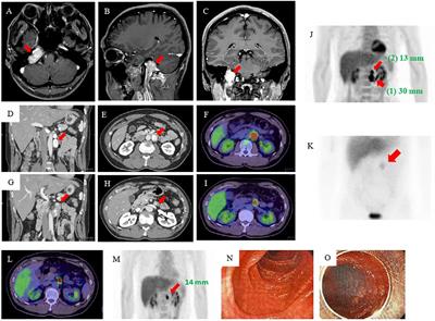 A rare case of multiple paragangliomas in the head and neck, retroperitoneum and duodenum: A case report and review of the literature